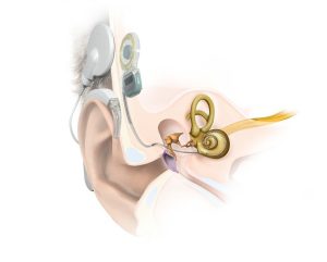 cochlear_works